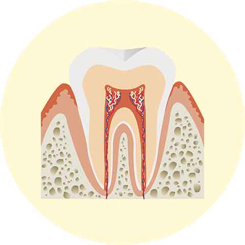 初期段階の虫歯