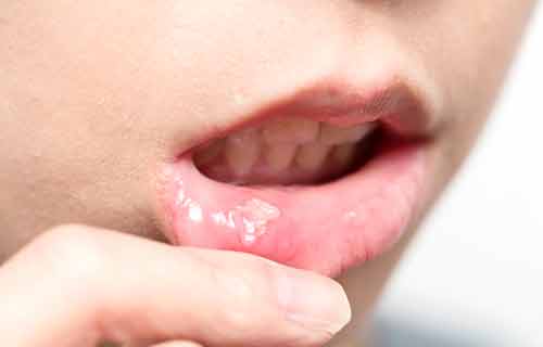 危険な口内炎の症状とは？