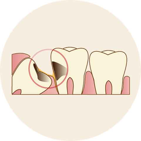 虫歯や歯周病になっている場合