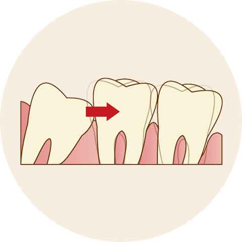 歯並びを乱す原因になっている場合