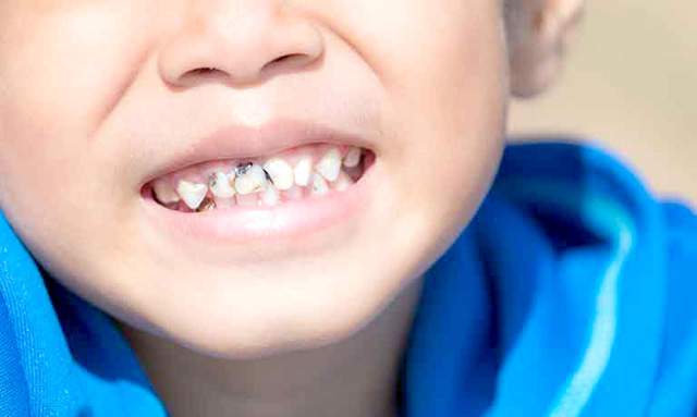 虫歯が進みやすい