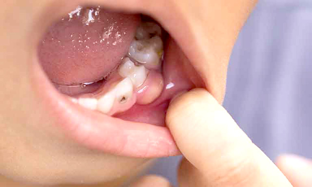 奥に永久歯が控えている